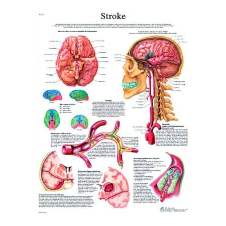 Fabrication Enterprises 3B Anatomical Chart - Stroke Chart, Laminated 12-4629L